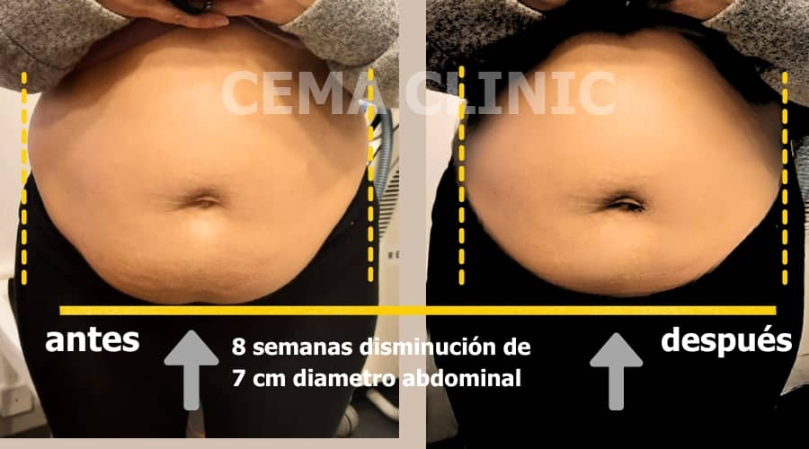 Obesidad antes y después en Vilanova i la geltru