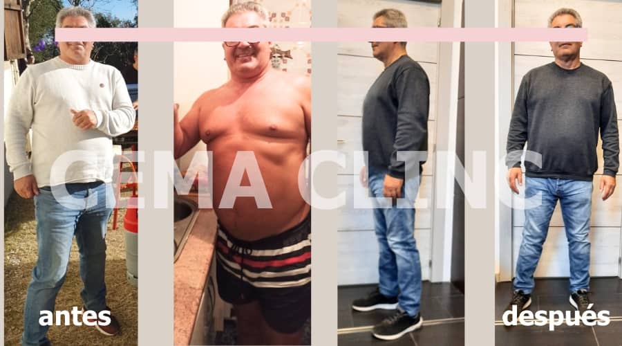 Sobrepeso y obesidad antes y despues hombre en vilanova