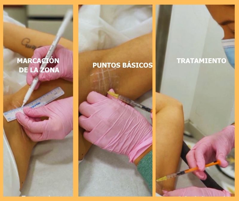 Marcación de la zona axilar en Vilanova i la Geltrú