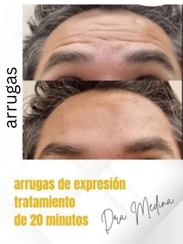 fotoenvejecimiento estética hombre en vilanova i la geltrú