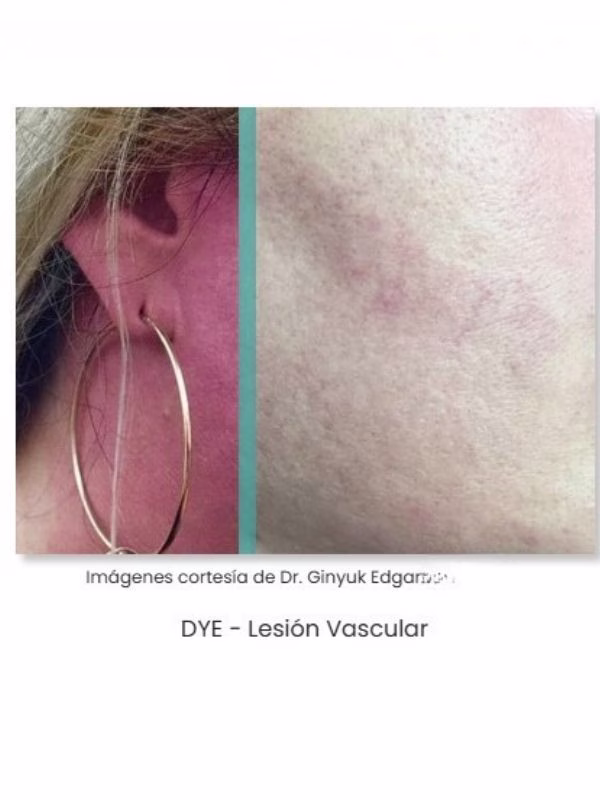 harmont ipl xl pro laser ipl harmony xl pro